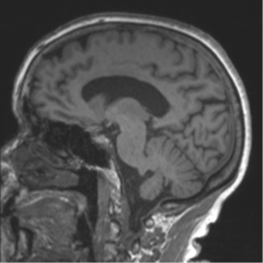 Chronic hypertensive encephalopathy (Radiopaedia 39993-42482 Sagittal T1 43).png