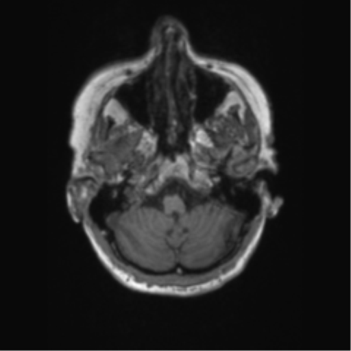 File:Chronic hypertensive encephalopathy (Radiopaedia 72844-83495 Axial T1 61).png
