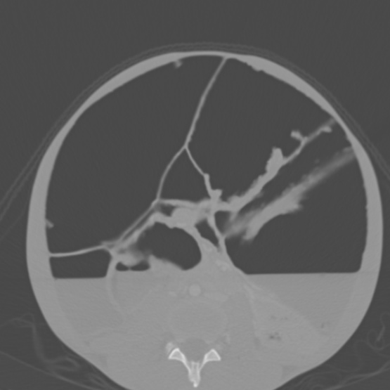 File:Chronic large bowel pseudo-obstruction (Radiopaedia 43181-46492 Axial bone window 105).jpg