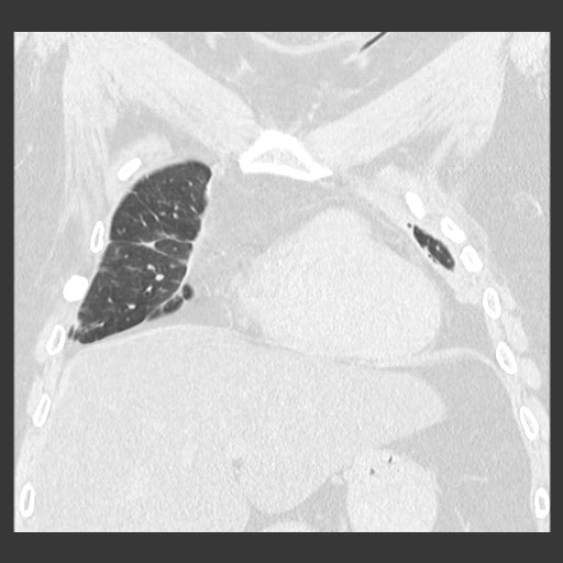 Chronic lung allograft dysfunction - restrictive form (Radiopaedia 60595-68316 Coronal lung window 36).jpg