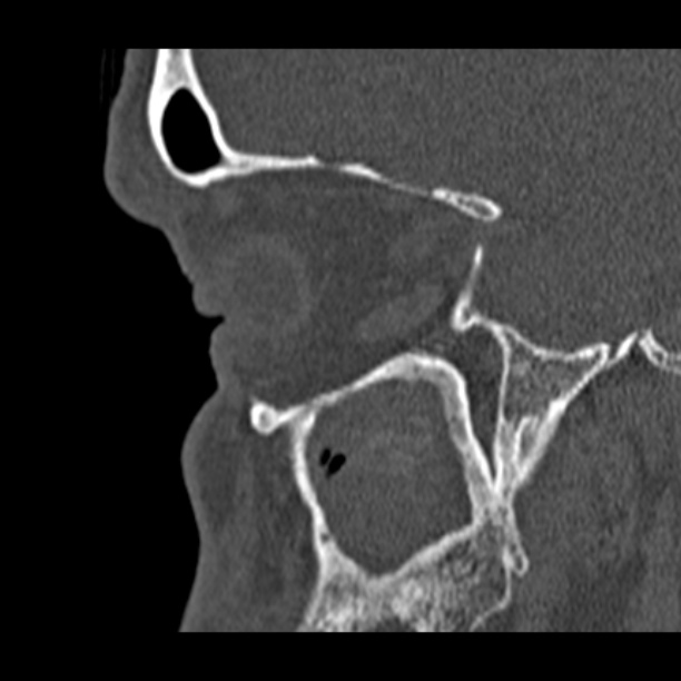 Chronic maxillary sinusitis (Radiopaedia 27879-28116 Sagittal bone window 12).jpg