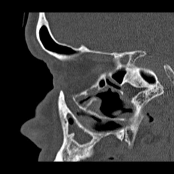 Chronic maxillary sinusitis (Radiopaedia 27879-28116 Sagittal bone window 17).jpg