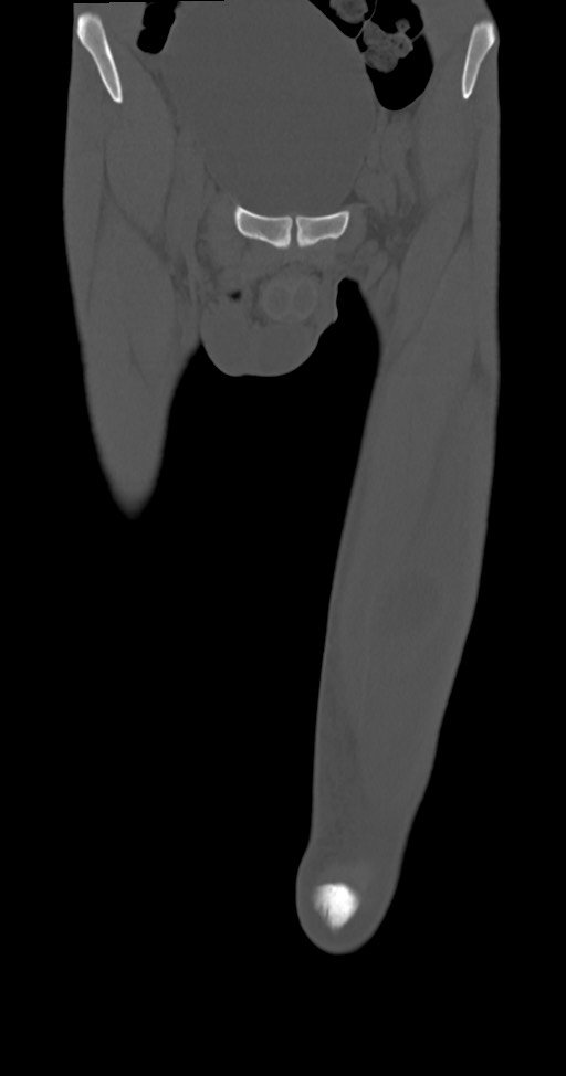 Chronic osteomyelitis (with sequestrum) (Radiopaedia 74813-85822 Coronal non-contrast 9).jpg