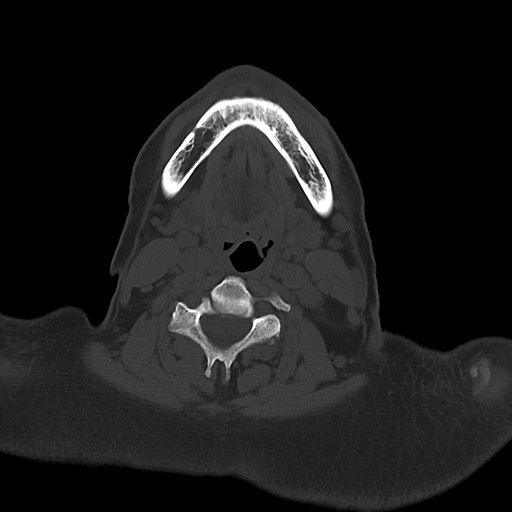 File:Chronic osteomyelitis - calvarial (severe) (Radiopaedia 69668-79616 Axial bone window 3).jpg