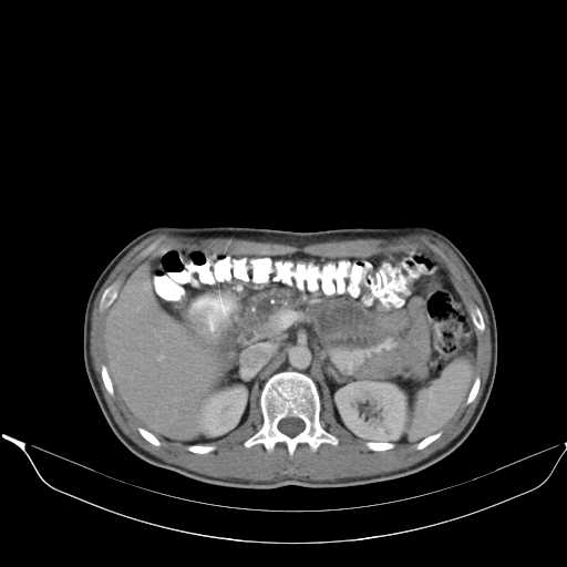 Chronic pancreatitis (Radiopaedia 21022-20949 A 23).jpg
