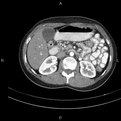 Chronic pancreatitis (Radiopaedia 64576-73450 B 60).jpg