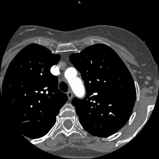 Chronic pulmonary embolism (Radiopaedia 73073-85094 Axial C+ CTPA 16).jpg