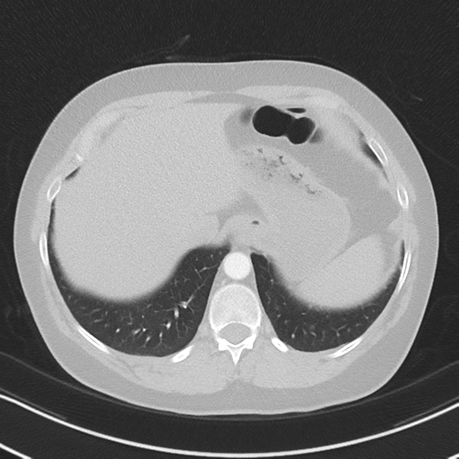 Chronic pulmonary embolus (Radiopaedia 39129-41341 Axial lung window 53).png