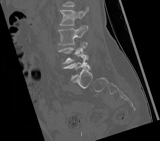 File:Chronic spinal hematoma with cauda equina syndrome (Radiopaedia 75745-88197 Sagittal bone window 22).png