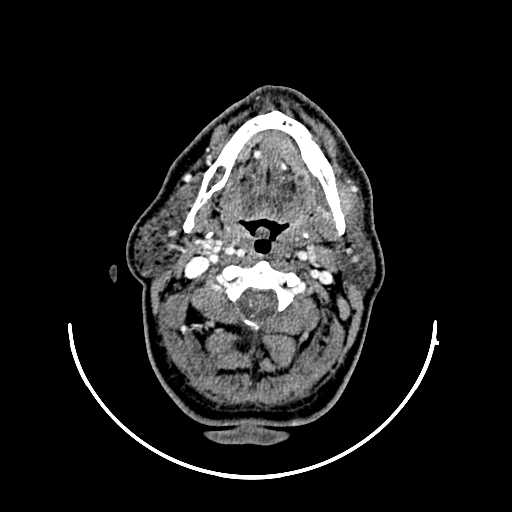 File:Chronic submandibular abscess (Radiopaedia 21738-21718 A 16).jpg