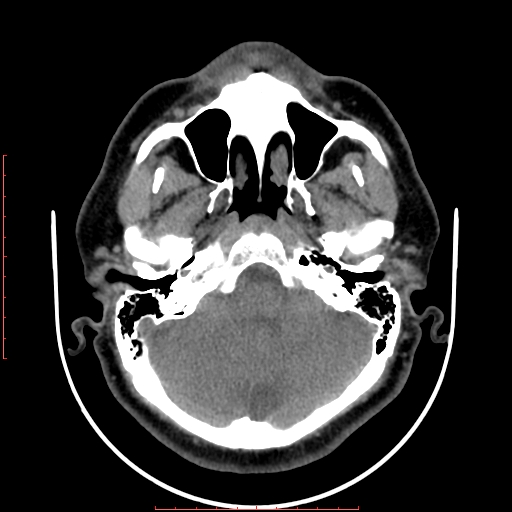 Chronic submandibular sialolithiasis (Radiopaedia 69817-79814 Axial non-contrast 11).jpg