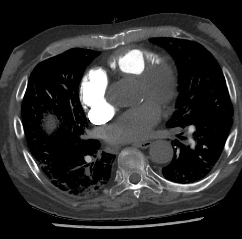 Chronic thromboembolic pulmonary disease (Radiopaedia 90694-108119 Axial C+ CTPA 57).jpg