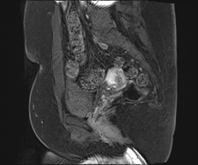 File:Class II Mullerian duct anomaly- unicornuate uterus with rudimentary horn and non-communicating cavity (Radiopaedia 39441-41755 G 68).jpg