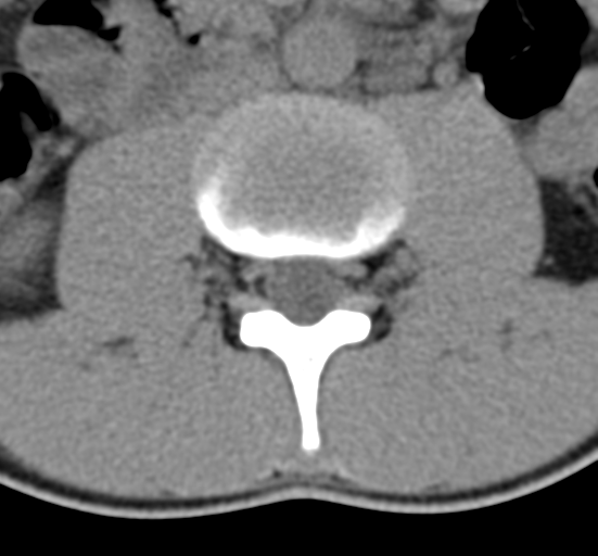 Clear cell meningoma - lumbar spine (Radiopaedia 60116-67691 Axial non-contrast 31).png