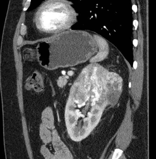 File:Clear cell renal cell carcinoma (Radiopaedia 61449-69393 D 24).jpg