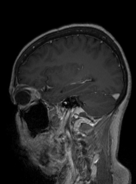 Clival meningioma (Radiopaedia 53278-59248 Sagittal T1 C+ 199).jpg