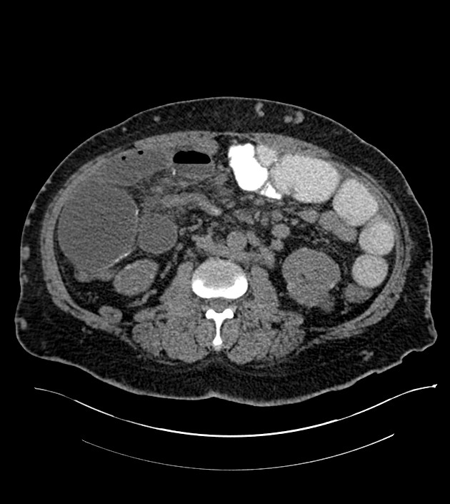 Closed-loop small bowel obstruction-internal hernia (Radiopaedia 78439-91096 Axial non-contrast 77).jpg