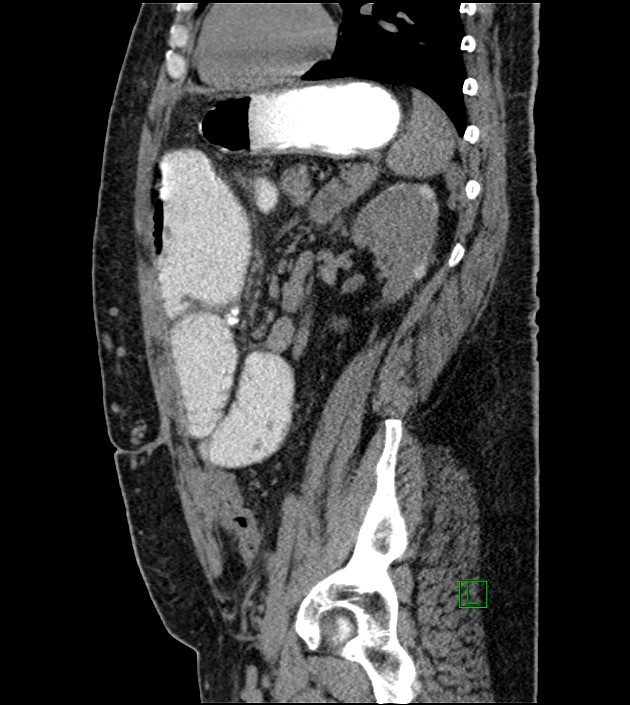 Closed-loop small bowel obstruction-internal hernia (Radiopaedia 78439-91096 C 55).jpg