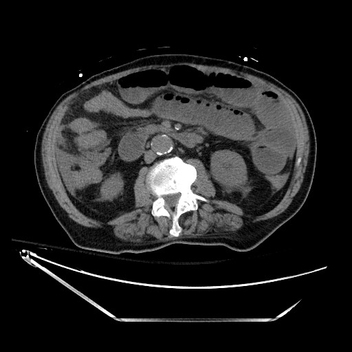 Closed loop obstruction due to adhesive band, resulting in small bowel ischemia and resection (Radiopaedia 83835-99023 Axial non-contrast 73).jpg