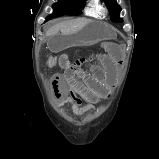 File:Closed loop obstruction due to adhesive band, resulting in small bowel ischemia and resection (Radiopaedia 83835-99023 C 30).jpg