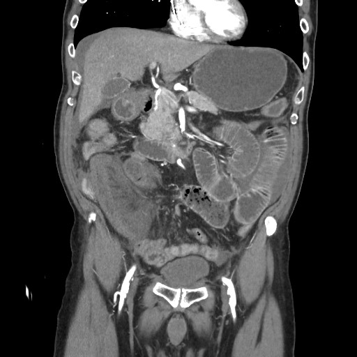 File:Closed loop obstruction due to adhesive band, resulting in small bowel ischemia and resection (Radiopaedia 83835-99023 C 51).jpg
