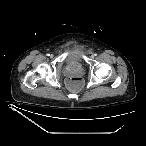 File:Closed loop obstruction due to adhesive band, resulting in small bowel ischemia and resection (Radiopaedia 83835-99023 D 149).jpg