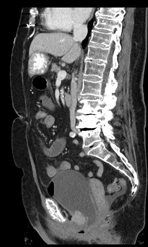 Closed loop small bowel obstruction - adhesions (Radiopaedia 59269-66611 C 60).jpg