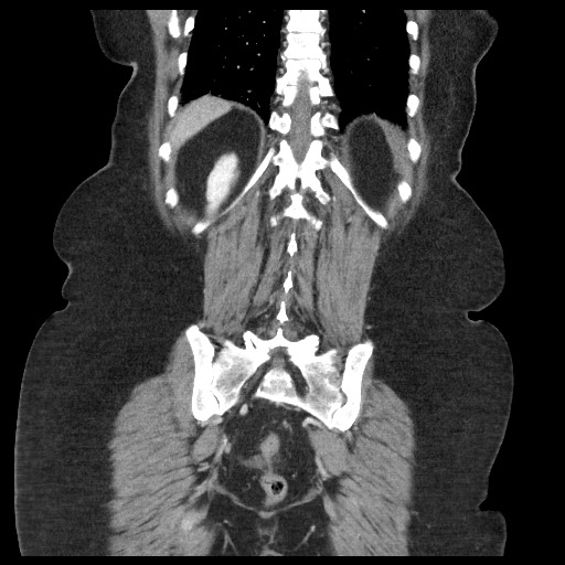 Closed loop small bowel obstruction - internal hernia (Radiopaedia 65402-74450 B 87).jpg