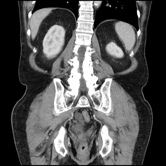 Closed loop small bowel obstruction due to adhesive band - U-shaped loop (Radiopaedia 83829-99012 B 38).jpg