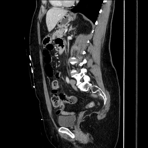 Closed loop small bowel obstruction due to adhesive bands - early and late images (Radiopaedia 83830-99014 C 107).jpg