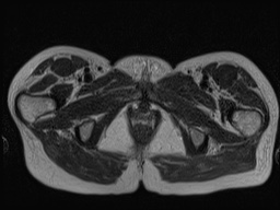 Closed loop small bowel obstruction in pregnancy (MRI) (Radiopaedia 87637-104031 D 44).jpg