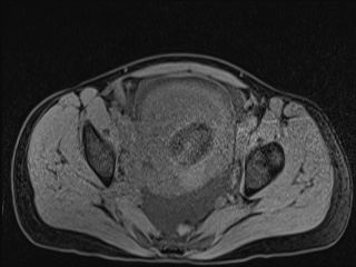 Closed loop small bowel obstruction in pregnancy (MRI) (Radiopaedia 87637-104031 F 54).jpg