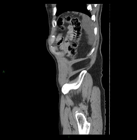 Closed loop small bowel obstruction with ischemia (Radiopaedia 84180-99456 C 82).jpg