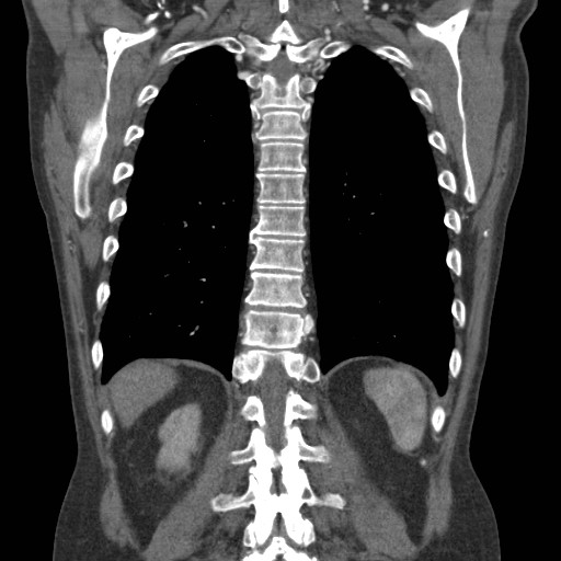 Coarctation of the aorta (Radiopaedia 17427-17116 A 24).jpg