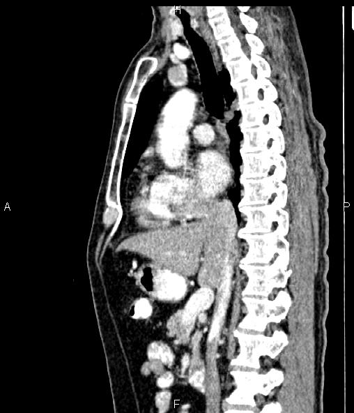 Colon adenocarcinoma (Radiopaedia 83266-97671 D 54).jpg