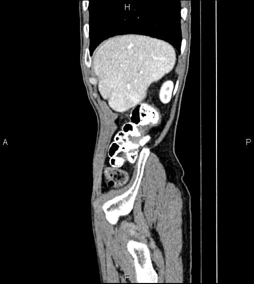 Colon adenocarcinoma - hepatic flexure (Radiopaedia 85635-101395 D 12).jpg