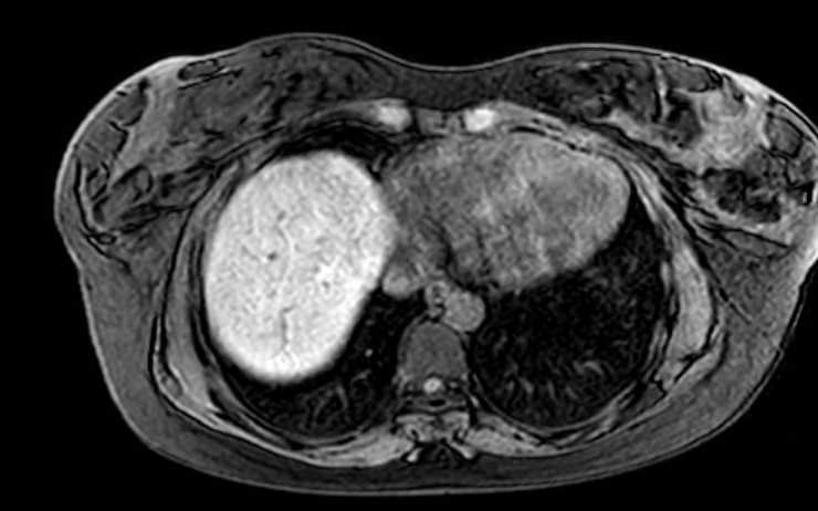 Colon adenocarcinoma with Krukenberg tumors, advanced pregnancy (Radiopaedia 67279-76645 A 77).jpg