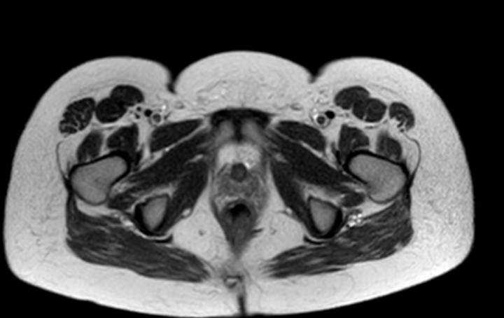 Colon adenocarcinoma with Krukenberg tumors, advanced pregnancy (Radiopaedia 67279-76645 Axial T2 2).jpg