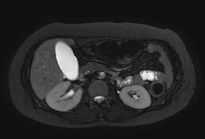 Colon adenocarcinoma with Krukenberg tumors, advanced pregnancy (Radiopaedia 67279-76645 Axial T2 SPAIR 53).jpg