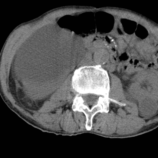 Colon cancer with calcified liver metastasis (Radiopaedia 74423-85309 Axial non-contrast 47).jpg