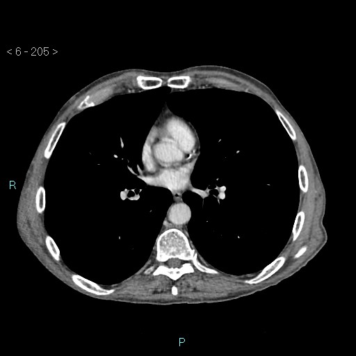 Colonic cancer (ultrasound and TC imaging) (Radiopaedia 50346-55713 B 205).jpg