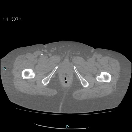 File:Colonic lipomas (Radiopaedia 49137-54244 Axial bone window 225).jpg