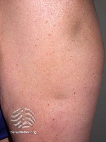 File:Lupus panniculitis (DermNet NZ immune-lupus-profundus2).jpg