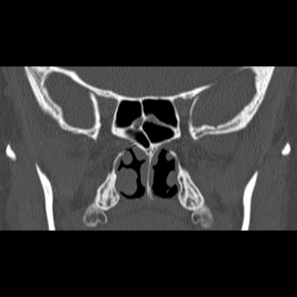 Nasal septal perforation (Radiopaedia 25030-25289 Coronal bone window 50).jpg