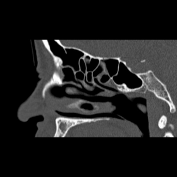 Nasal septal perforation (Radiopaedia 25030-25289 Sagittal bone window 40).jpg