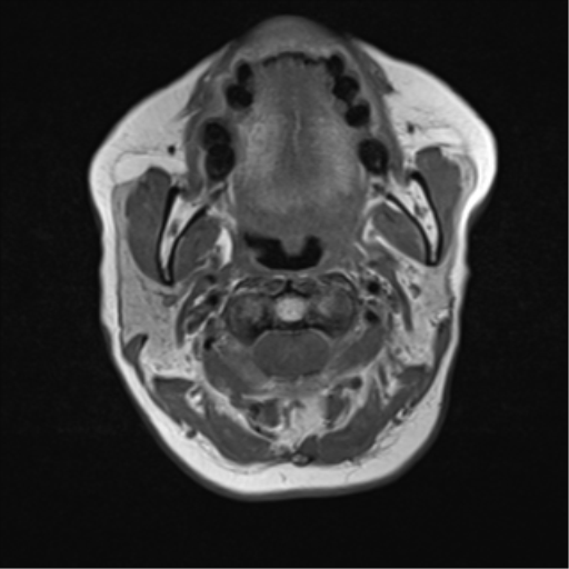 File:Nasopharyngeal carcinoma with cerebral abscess (Radiopaedia 43018-46273 Axial T1 25).png