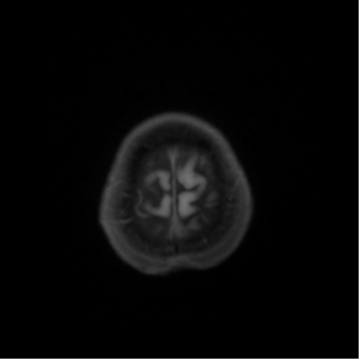 File:Nasopharyngeal carcinoma with cerebral abscess (Radiopaedia 43018-46274 Axial T1 fat sat 47).png