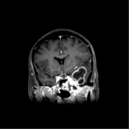 File:Nasopharyngeal carcinoma with cerebral abscess (Radiopaedia 43018-46274 L 23).png
