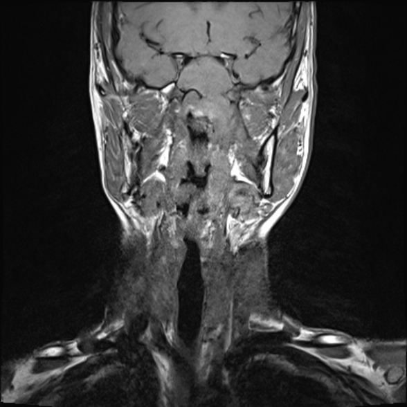 Nasopharyngeal carcinoma with skull base invasion (Radiopaedia 53415-59485 Coronal T1 23).jpg