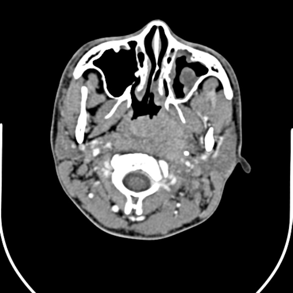 File:Nasopharyngeal carcinoma with skull base invasion (Radiopaedia 53415-59705 A 57).jpg